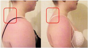 Formación de un cojín muscular en la osteocondrosis cervical. 