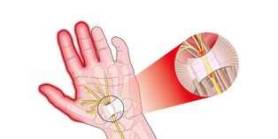 dolor en las articulaciones de los dedos con rizartrosis