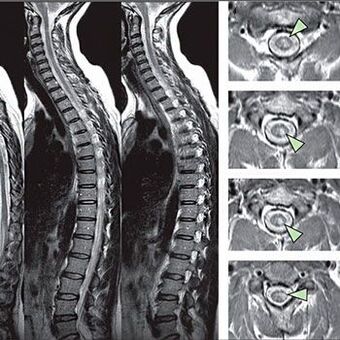 diagnóstico de osteocondrosis torácica