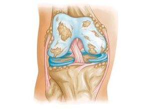 daño a la articulación de la rodilla con artrosis