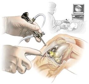 artroscopia para el dolor de rodilla