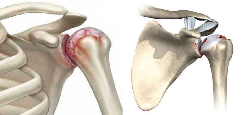 destrucción de la articulación del hombro con artrosis