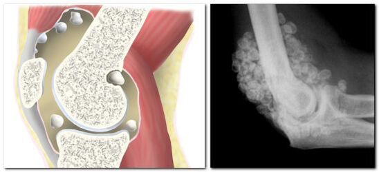 condromatosis con dolor en la articulación de la cadera